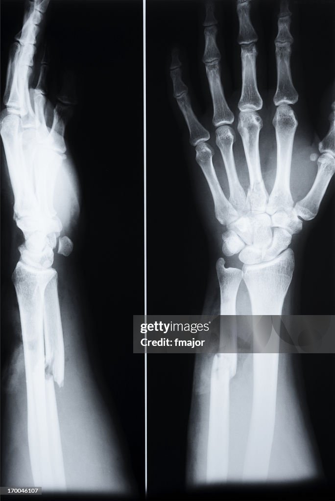 Fracture Of Ulna(Arm) and third metacarp(hand)