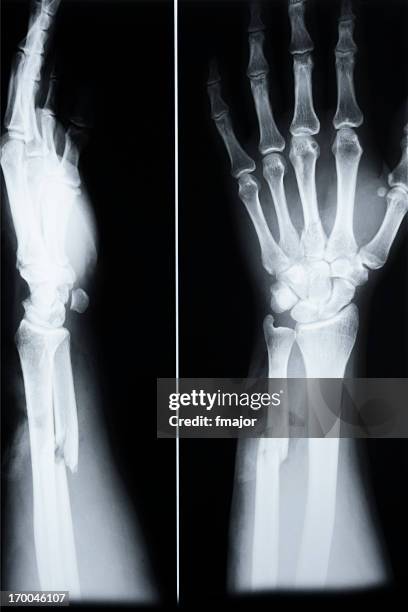 fracture of ulna(arm) and third metacarp(hand) - x ray arm stock pictures, royalty-free photos & images
