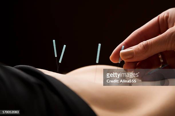 woman getting acupuncture treatment at the spa - acupuncture stockfoto's en -beelden