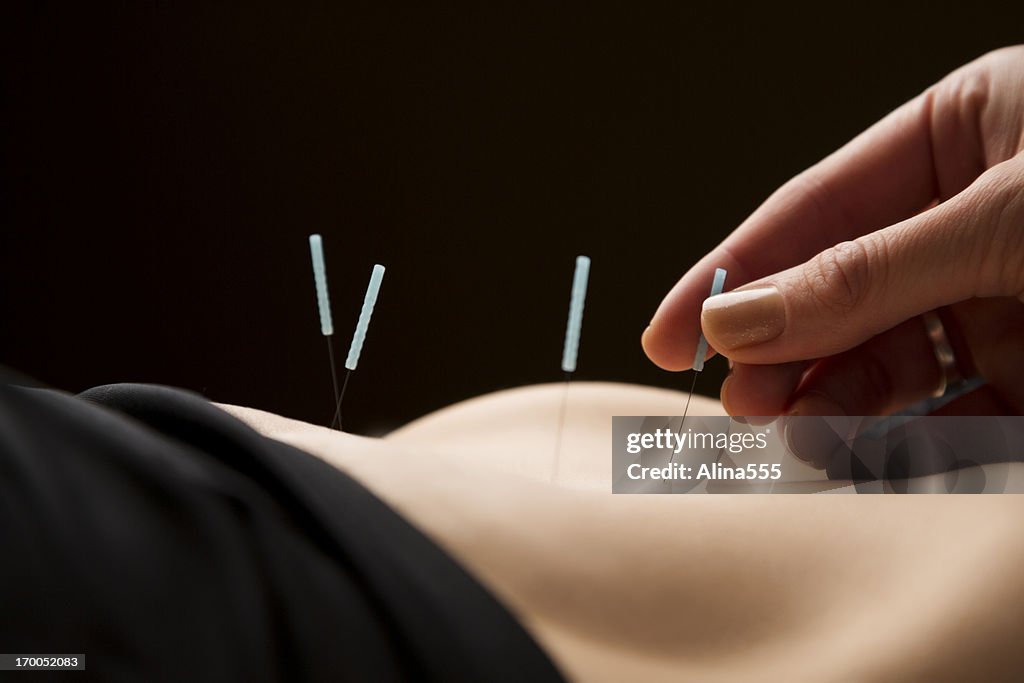 Woman getting acupuncture treatment at the spa
