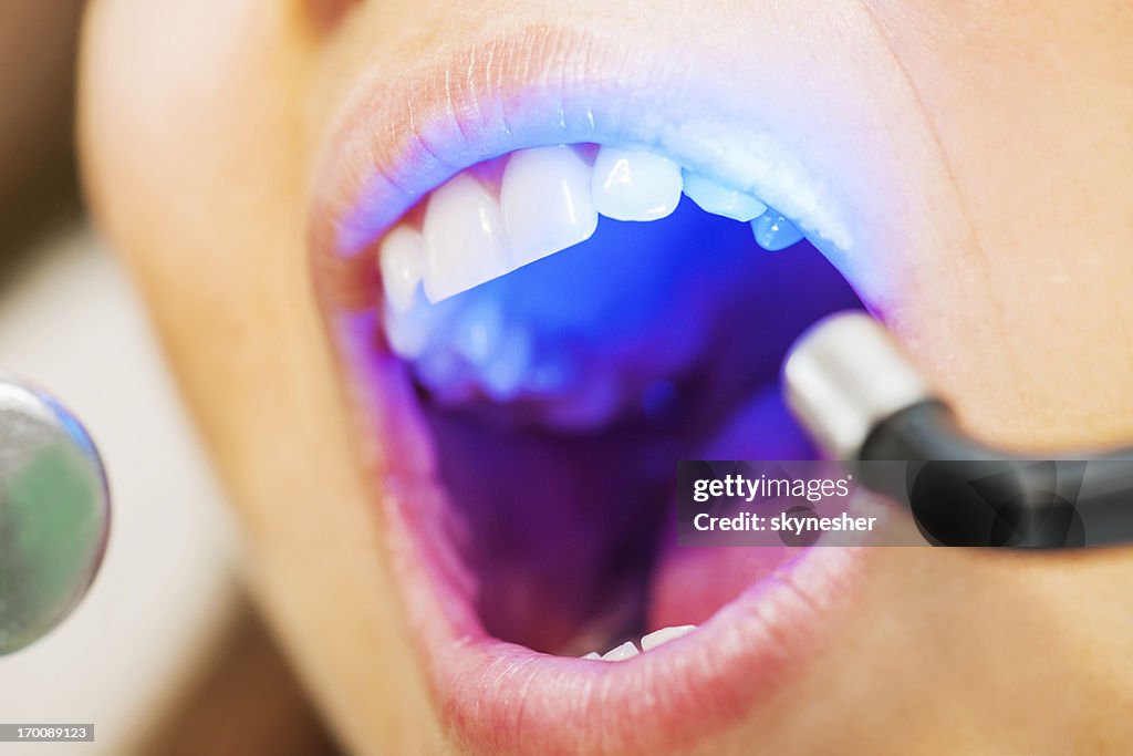 Ultraviolet dental treatment.