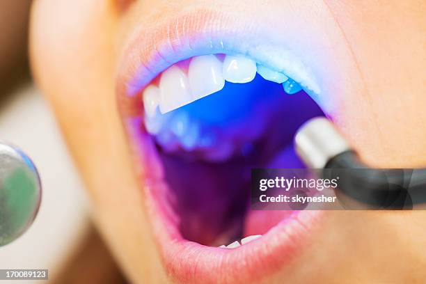 ultraviolet dental treatment. - lazer 個照片及圖片檔