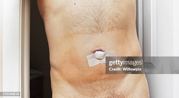 post surgery umbilical hernia - guy with scar stock pictures, royalty-free photos & images