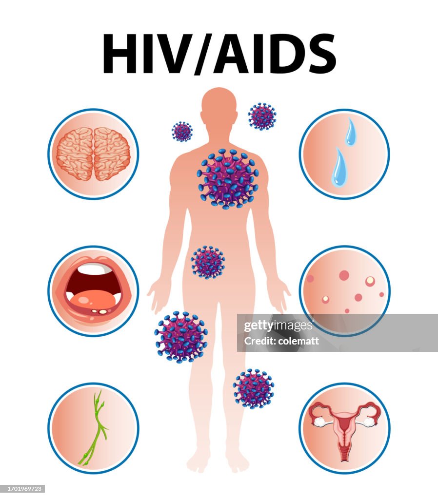 Hiv In Body Hiv Aids Virus Effects On Immune System And Body High-Res Vector ...