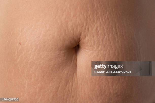 cropped view of the mum belly full of stretch marks after pregnancy. tummy flabby skin on a fat belly. postpartum belly with stretch marks. body acceptance concept - big fat white women 個照片及圖片檔