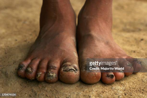 Feet of a child from the Yanomami tribe. Considered the Native Americans of South America, the forest-dwelling tribe live in the Amazon rainforest on...