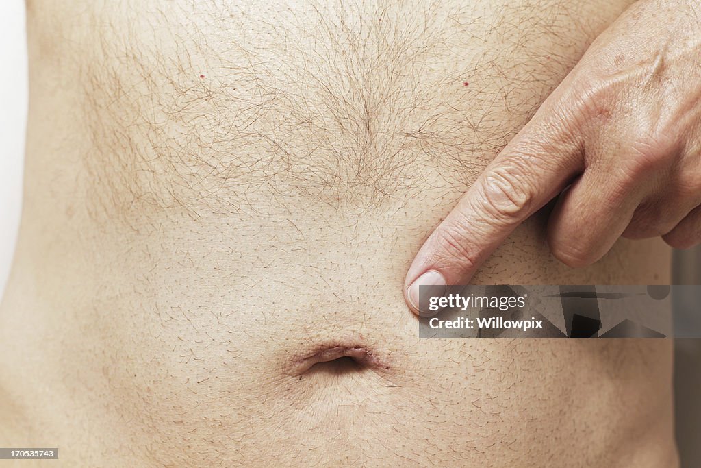 Man Pointing To Belly Button Scar