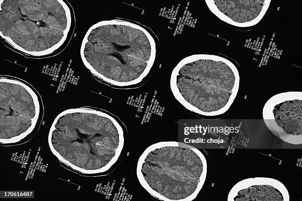 cat scan of human brain - skull xray no brain stock pictures, royalty-free photos & images