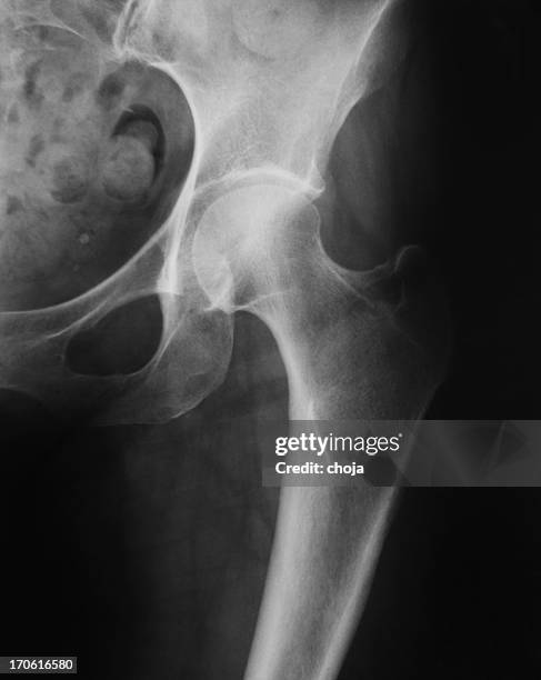 x-ry image of left human hip - acetabulum stock pictures, royalty-free photos & images