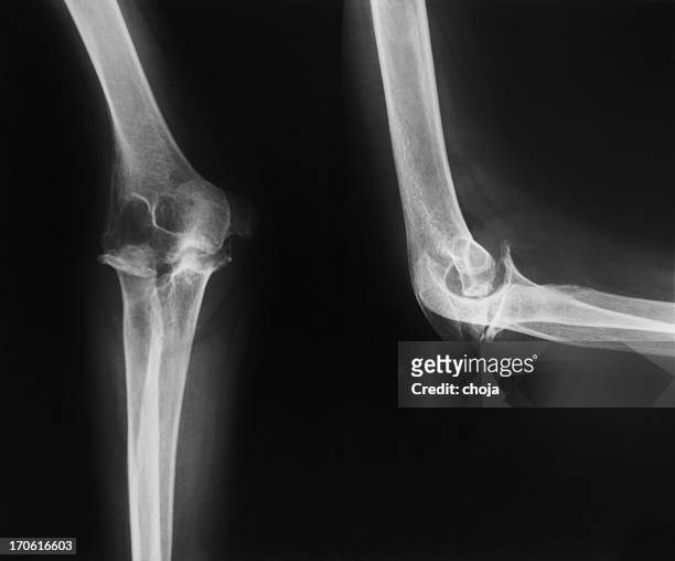 x-ray image elbow.person mit rheumatische arthritis - ellenbogen stock-fotos und bilder
