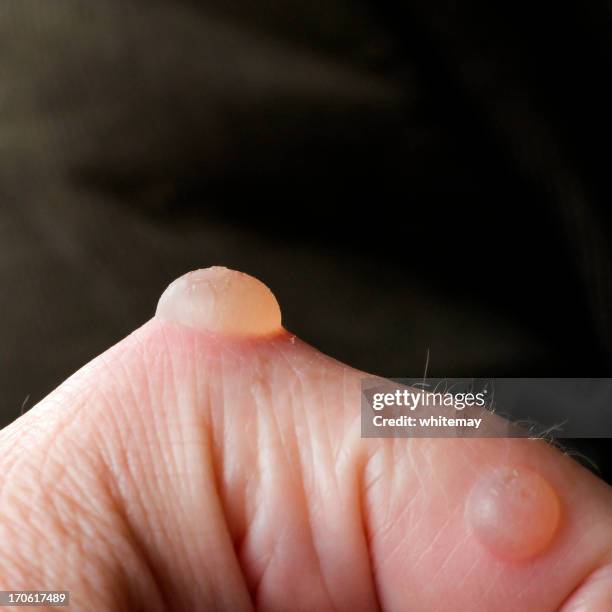 2 978点の水膨れのストックフォト Getty Images 2 978点の水膨れのストックフォト Getty Images
