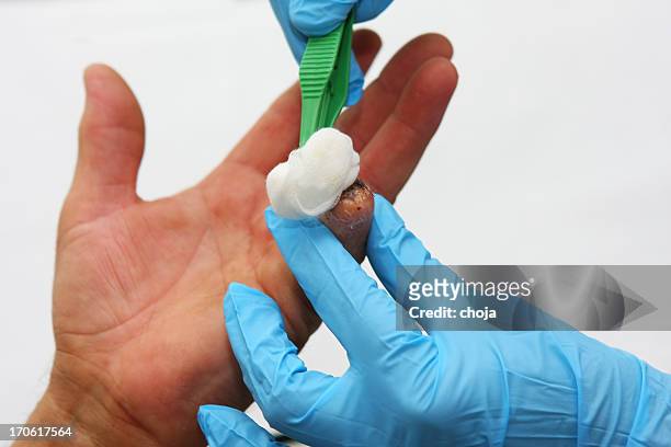 krankenschwester beim arbeiten, verändert bandage mit verletzten patienten finger - amputated finger stock-fotos und bilder