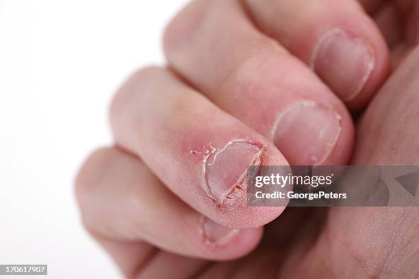 nail biting - nail biting stock pictures, royalty-free photos & images