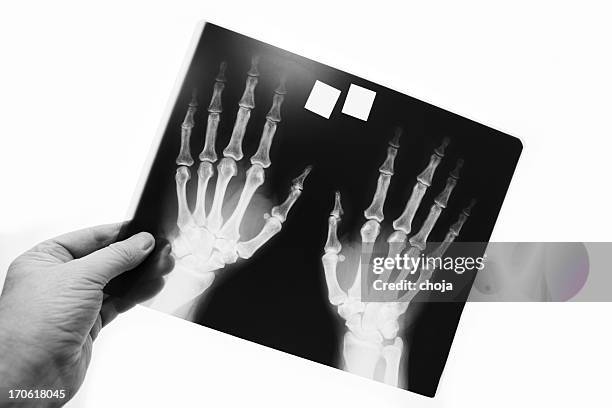 x-ray image of human wrist with arthritis - rheumatism stock pictures, royalty-free photos & images