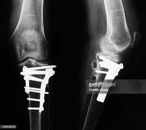x-ray image of broken legs with osteosynthetic material - titanium stock pictures, royalty-free photos & images