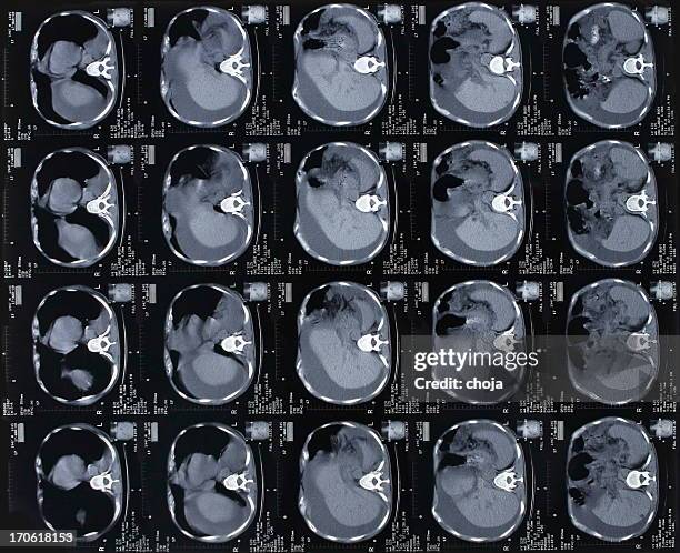 cat scan of abdomen with stomach cancer - bowel cancer stock pictures, royalty-free photos & images