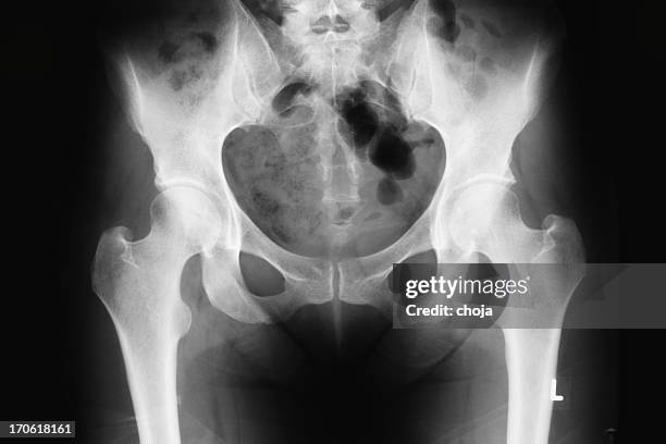 imagen de rayos x - femur fotografías e imágenes de stock