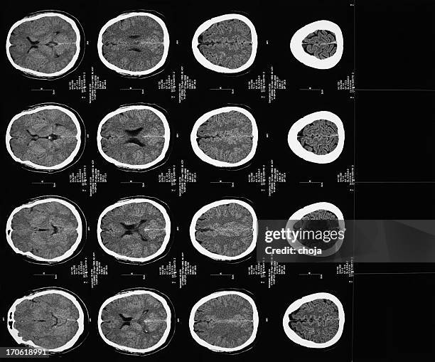 Bone Brain Scan 93 Bone Scan Machine Stock Photos, High-Res Pictures, and Images ...