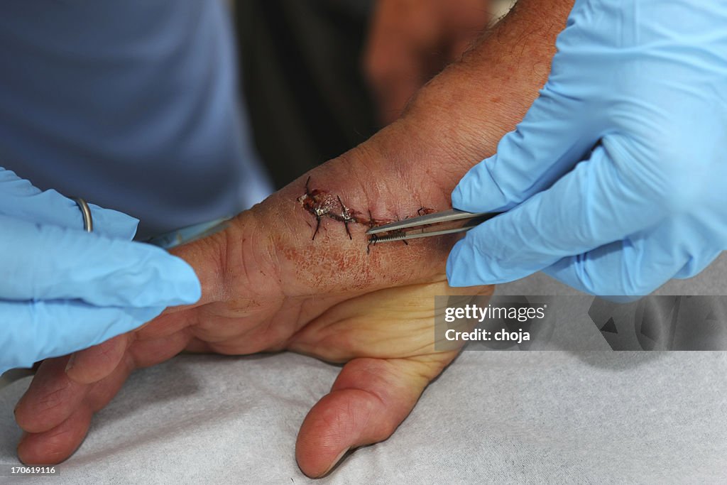 Nurse is removing stitches from a wound on patients hand