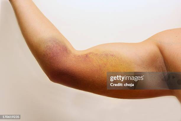 jovem do braço após o acidente - hemangioma - fotografias e filmes do acervo
