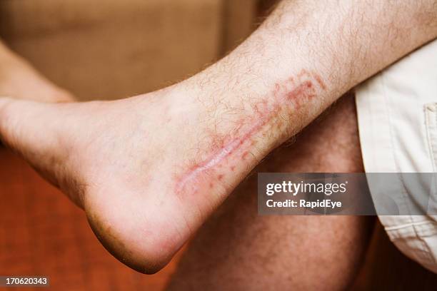 achilles tendon scar - mark stock pictures, royalty-free photos & images