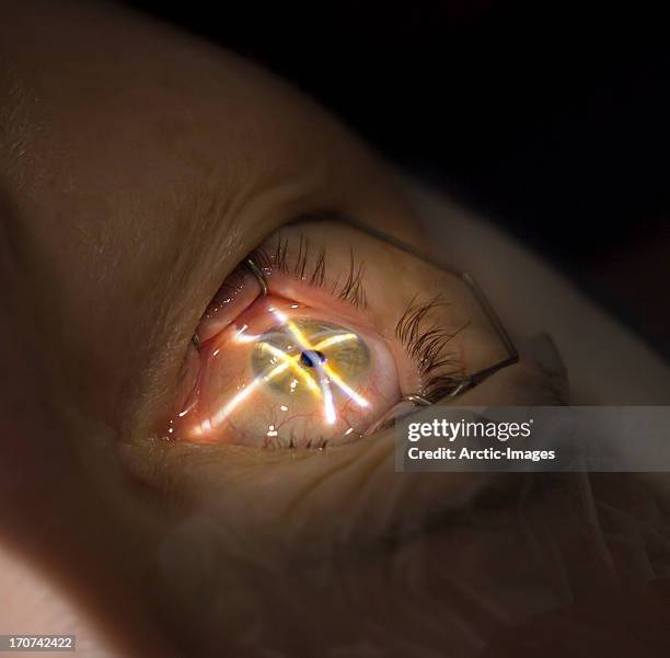 laser eye surgery - cor do olho humano imagens e fotografias de stock