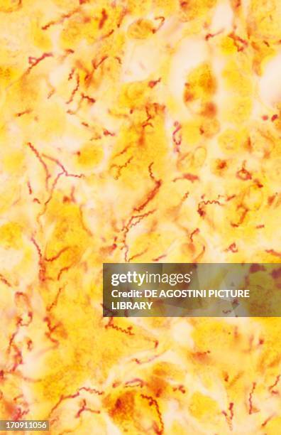 Microscopic Syphilis Sample Syphilis Microscope Photos and Premium High Res Pictures - Getty Images