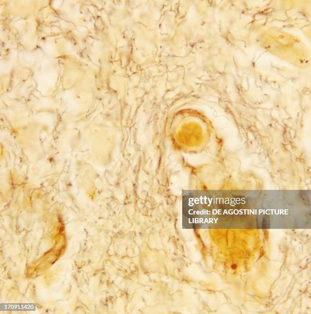 Microscopic Syphilis Sample 32 Syphilis Microscope Stock Photos, High-Res Pictures, and Images ...