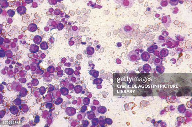 Section of bone marrow affected by myeloma seen under a microscope.
