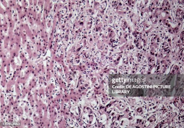 Section of metastatic adenocarcinoma in a human liver seen under a microscope.