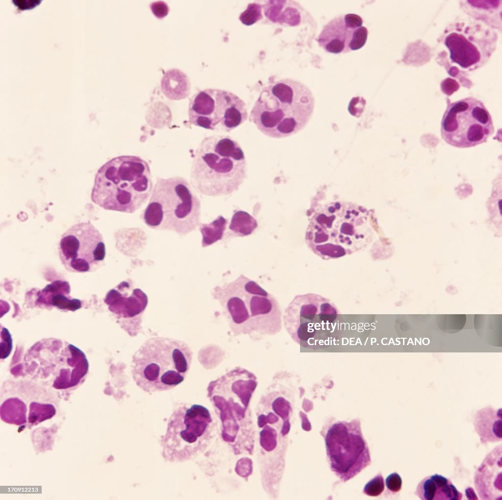 Pust Under Microscope Smear of human pus seen under a microscope, at x500 magnification. News ...