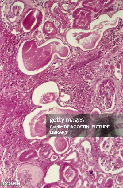 Histologic slide of chronic pyelonephritis, with severly dilated renal tubules and contain proteinaceous material with interstitial infiltration of...