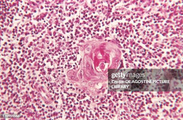 Microphotograph of Hassall's corpuscle in the medulla of the thymus, histologic specimen stained with hematoxylin.