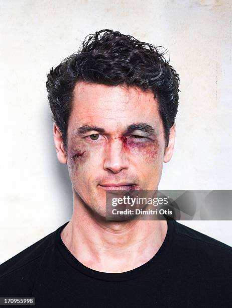 man's face severely beaten up after fight - bruise fotografías e imágenes de stock