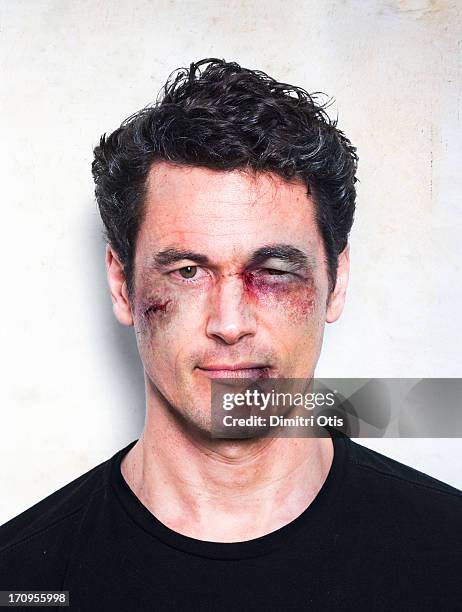 man's face severely beaten up after fight - black eye stockfoto's en -beelden