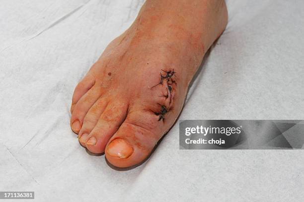 patient after bunion operation hallux valgus - valgus stock pictures, royalty-free photos & images