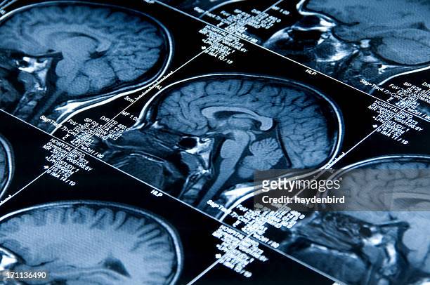 mri brain scan showing multiple images of head and skull - skull xray no brain stock pictures, royalty-free photos & images