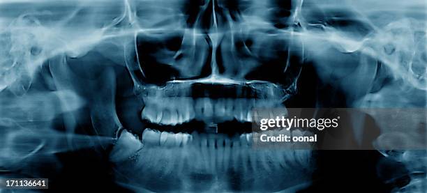 dental xray - root canal procedure stock pictures, royalty-free photos & images