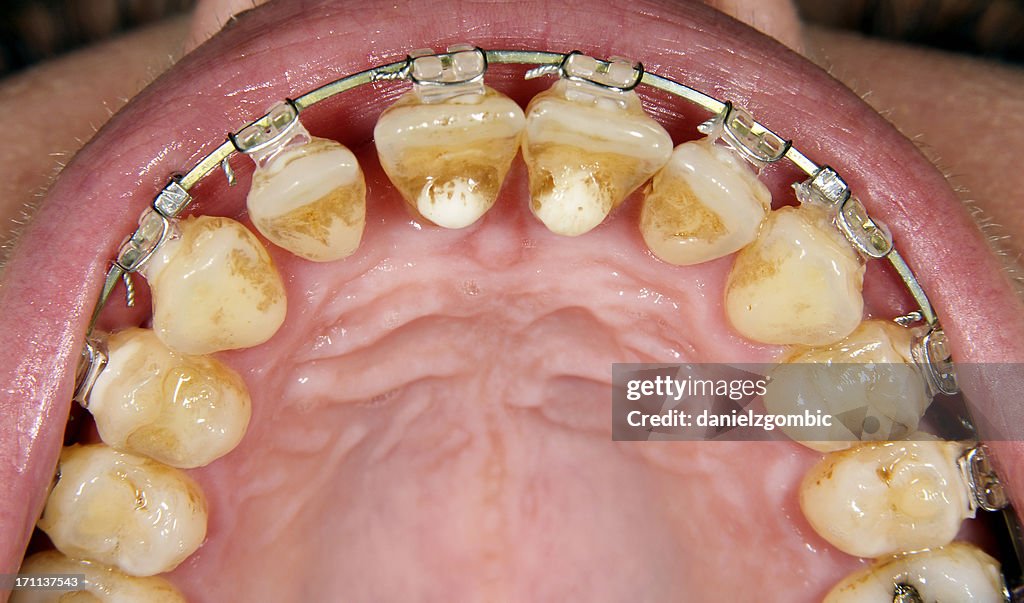 Orthodontic Treatment With Gingival Recesion