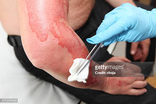 nurse is taking care of patient with burns,cleaning wound - brandde stockfoto's en -beelden