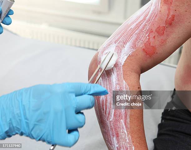 nurse is taking care of patient with burns,cleaning wound - burning stock pictures, royalty-free photos & images