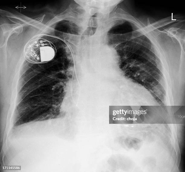 1,414 Pacemaker Images Stock Photos, High-Res Pictures, and Images ...