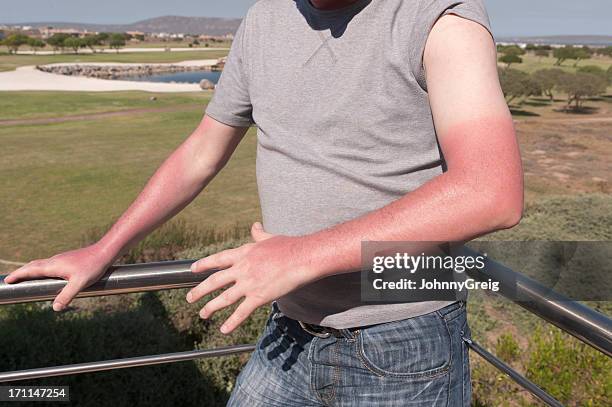 quemaduras de sol - raya del bronceado fotografías e imágenes de stock