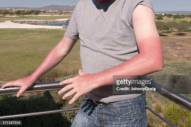 sunburn - sunburned stock pictures, royalty-free photos & images
