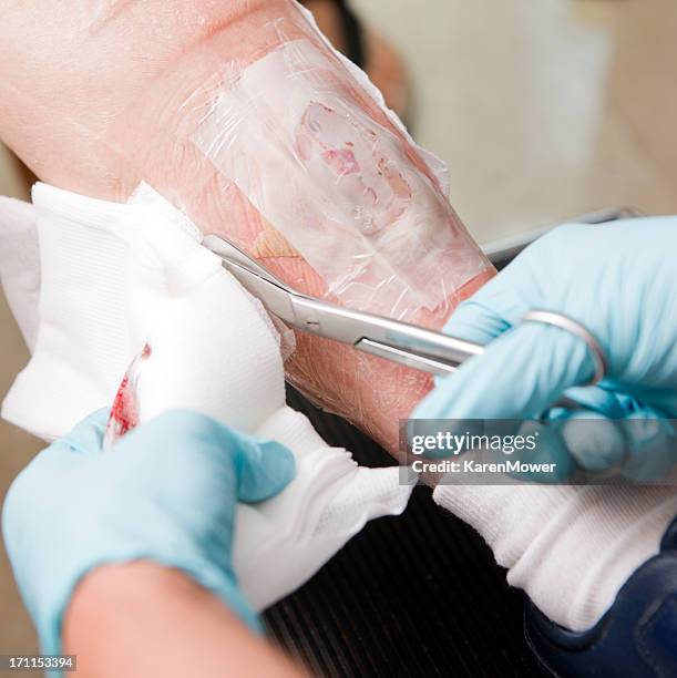 maggot therapy - bloody leg stock pictures, royalty-free photos & images