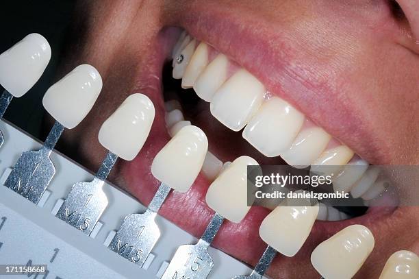 dental allo scolorimento trattamento - sbiancamento dentale foto e immagini stock
