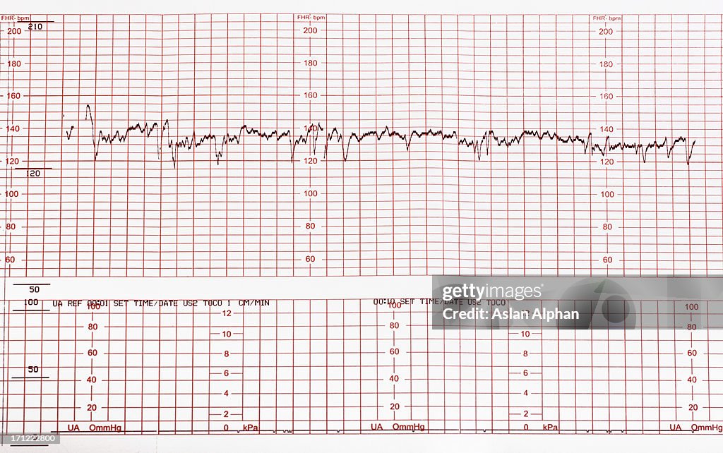 Medical cardiogram chart with results
