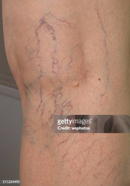 arañas vasculares humanas en primer plano de la pierna - varices fotografías e imágenes de stock