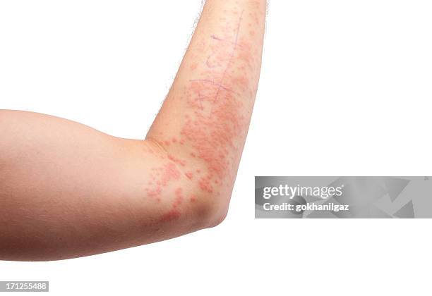 skin allergy -6 - dermatitis stock pictures, royalty-free photos & images