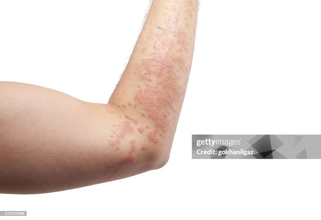 Pele alergia -6
